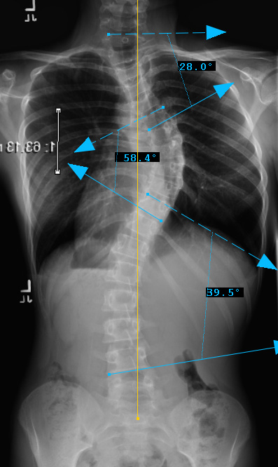 1. PREOP PA - 3bminus
