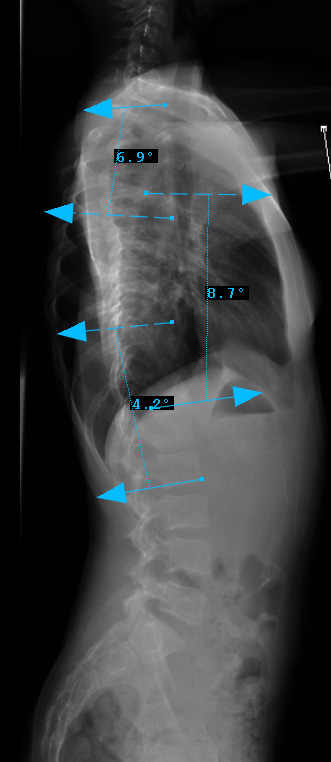 2. PREOP LAT - 3bminus