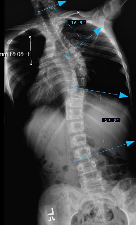 3. PREOP LEFT BEND - 3bminus
