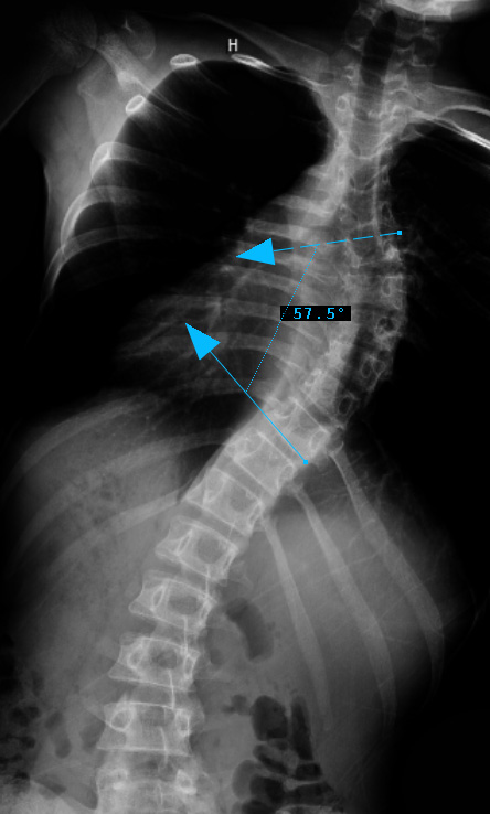 4. PREOP RIGHT BEND - 3bminus